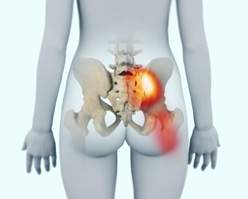 A dysfunctional SI joint may inflame the joint and surrounding nerves causing pain in the lower back, hip, groin, or pelvis.