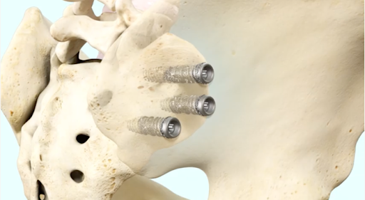 The iFuse TORQ Implant System typically involves placing three threaded titanium implants across the SI joint to maximize stability.
