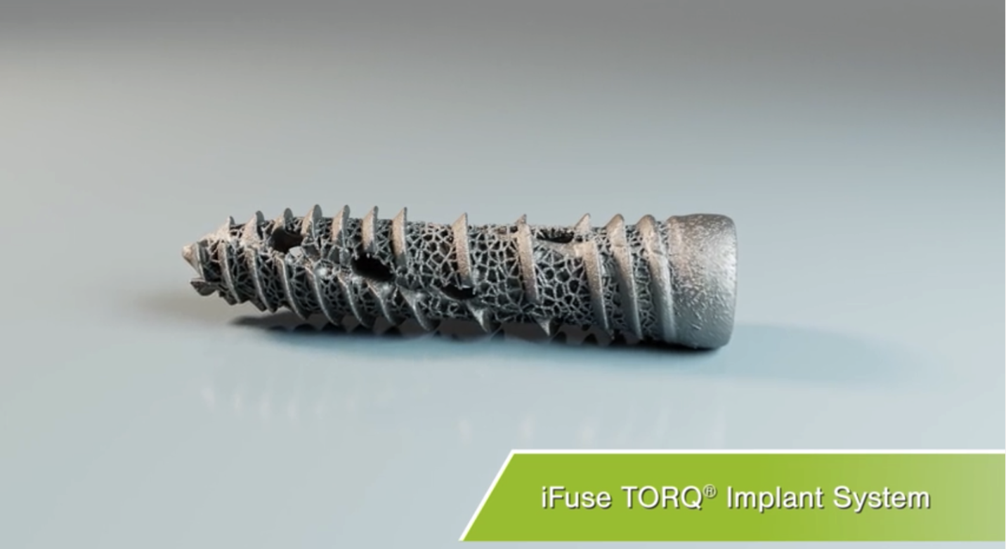 The 3D printed surface of iFuse TORQ is similar to cancellous bone and has the same iFuse Technology® used in SI-BONE’s original triangular, titanium implants.
