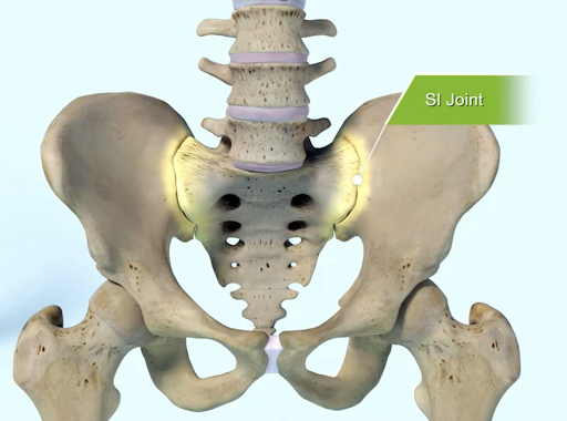 The SI joint is the link between the ilium, in the pelvis, to the sacrum, which is the lowest part of the spine above the tailbone.
